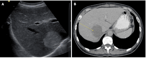 
Siêu âm gan và chụp cắt lớp vi tính ổ bụng có cản quang của một bệnh nhân u máu gan (55 mm × 46 mm). A: Hình ảnh siêu âm; B: Hình ảnh chụp cắt lớp vi tính.
