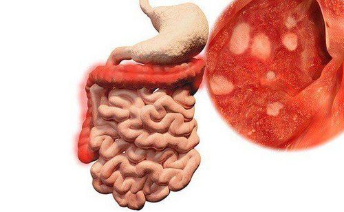 New therapeutic mechanisms in the treatment of inflammatory bowel disease