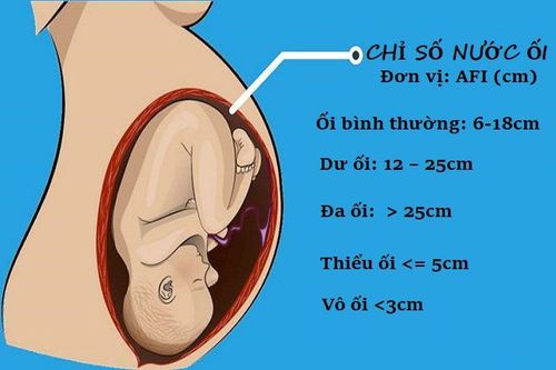 Mang thai đôi tuần 25 bị dư ối, góc ối sâu nhất là 81mm có nguy hiểm không?