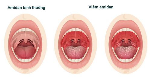 Cách điều trị bé bị viêm amidan hay ói và sốt liên tục?