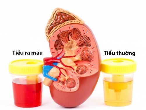 Có cảm giác muốn đi tiểu nhưng tiểu rắt, tiểu ra máu là triệu chứng bệnh gì?