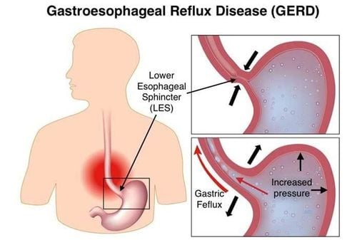 
Cơ thắt thực quản dưới (Lower esophageal Sphincter –LES) đóng vai trò quan trọng trong chứng ợ nóng
