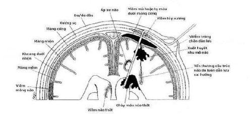 Technical procedure for draining the ventricles out