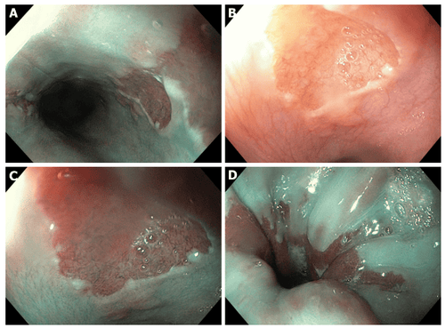 Treatment and screening of gastric mucosa ectopic in the esophagus