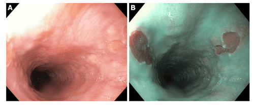 Standard narrow band versus magnification endoscopy for the diagnosis of Helicobacter pylori infection and precancerous conditions of the stomach