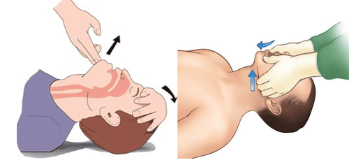 
Động tác làm thông thoáng đường thở Ngửa đầu – nâng cằm (trái) và Đẩy hàm (phải - nếu nghi ngờ tổn thương cột sống cổ)
