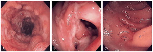 
Tổn thương của bệnh Crohn ở đại tràng được nhìn thấy qua nội soi đại tràng
