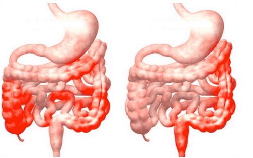 
Đặc điểm tổn thương của bệnh Crohn là tổn thương từng đoạn không liên tục trên ống tiêu hoá
