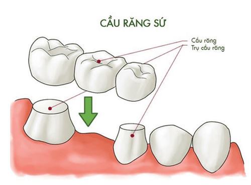 
Hình ảnh cầu răng sứ
