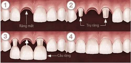 
Hình ảnh cầu răng sứ truyền thống
