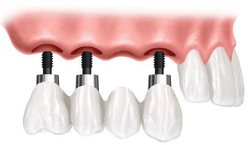 
Cầu răng sứ trên trụ Implant
