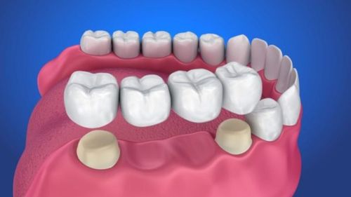 Is porcelain dental bridge good?