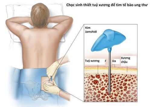 
Quá trình thực hiện sinh thiết tủy xương gồm 5 bước như trên.
