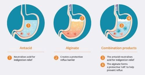 
Cơ chế của nhóm thuốc Alginate trong điều trị GERD
