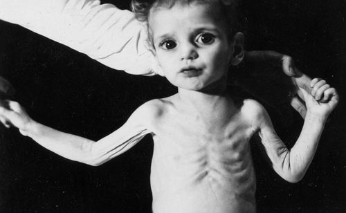 Complications of severe malnutrition