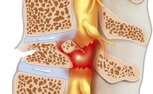 What medical technique is used to diagnose spinal cord injury?