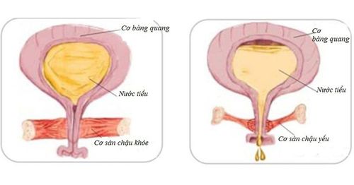 Tiểu són, nước tiểu nặng mùi, đau vùng thắt lưng là triệu chứng của bệnh gì?