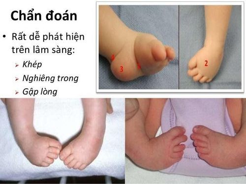 Can thiệp sớm bàn chân nghiêng trong ở trẻ sơ sinh