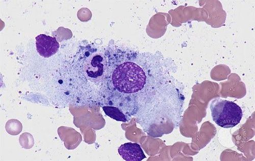 Body cavity fluid cytology: Typical cell morphology in benign effusions