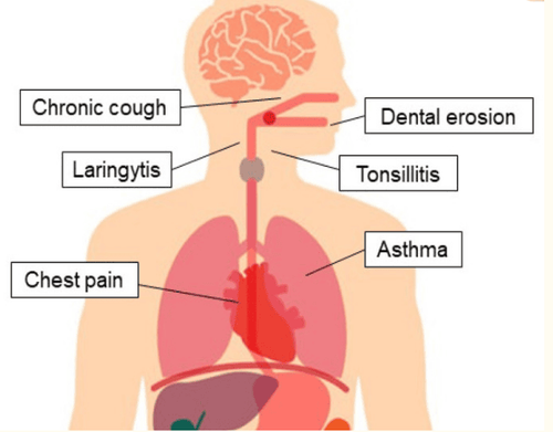 
Các biểu hiện ngoài thực quản của bệnh trào ngược dạ dày thực quản.
