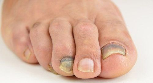 Nguyên nhân và cách điều trị bàn chân tím ngắt, móng chân chuyển sang màu đen và da chuyển màu đỏ?