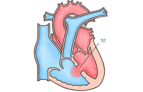 Ventricular septal defect, valve atrophy and pulmonary artery