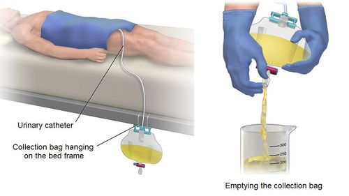 Technique of performing bladder drainage on the pubic bone