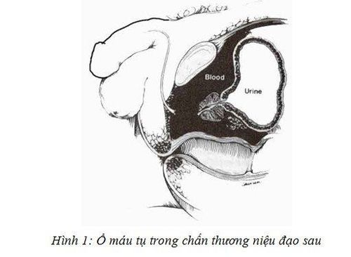 
Các chấn thương niệu đạo chưa được tạo hình làm bí tiểu được chỉ định dẫn lưu bàng quang
