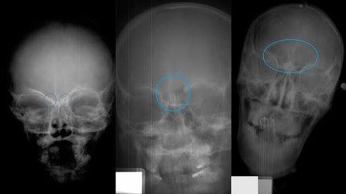 List of common sinus X-ray positions