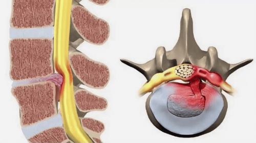 Can a bulging disc be diagnosed with an MRI of the spine?