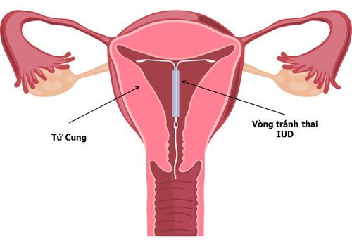 Can I put on gynecological medicine while I'm having an IUD?