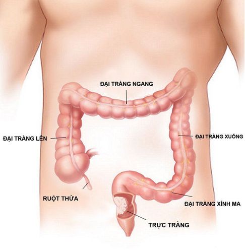 Gastrointestinal manifestations of ulcerative colitis with bleeding