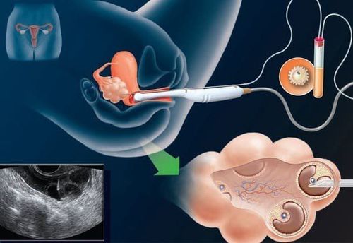 
Quá trình chọc hút trứng qua ngã âm đạo, dưới hướng dẫn siêu âm
