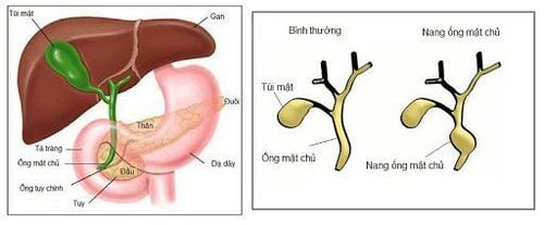 Why is the common bile duct cyst removed?