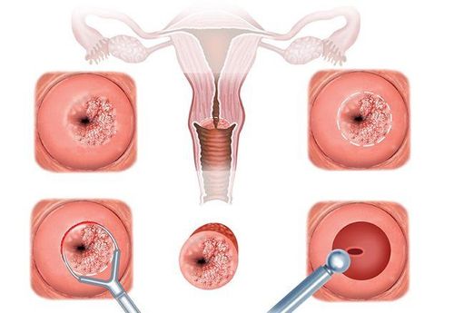 Chảy nhiều dịch nước vón màu hồng và một chút máu sau đốt viêm lộ tuyến có sao không?