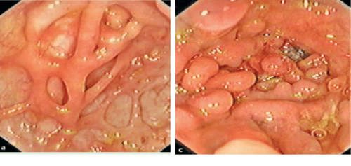 
Hình ảnh giả polyp và sẹo loét cũ trong viêm loét đại tràng chảy máu
