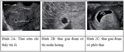 Some updates on ultrasound diagnosis of ectopic pregnancy