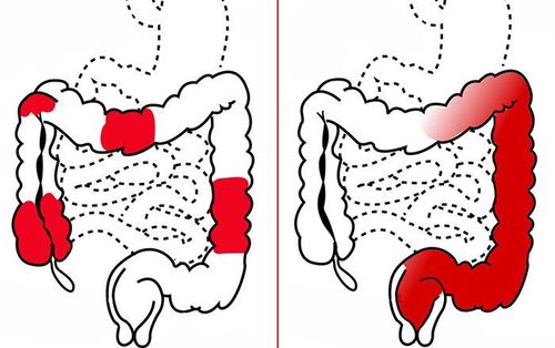 Ocular manifestations of hemorrhagic ulcerative colitis