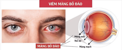 
Viêm màng bồ đào thường gặp ở bệnh viêm loét đại trực tràng chảy máu từ 2 đến 5%
