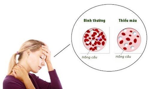 
Thiếu máu và mệt mỏi sẽ ảnh hưởng rất lớn đến hoạt động hàng ngày của bạn
