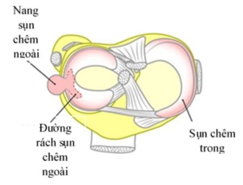 
Khớp gối bị nang sụn chêm
