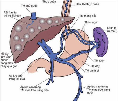 Portal hypertension in children with congenital biliary atresia