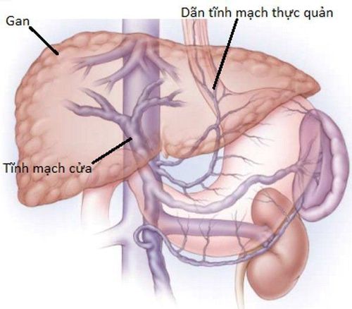 
Giãn tĩnh mạch thực quản là một biểu hiện của trẻ bị teo mật bẩm sinh
