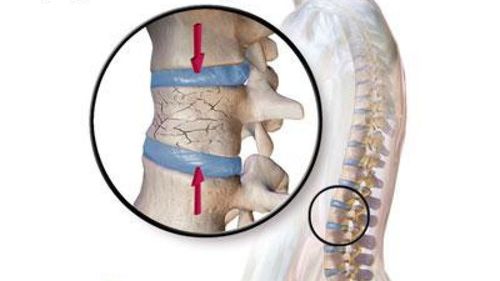 Xẹp đốt sống L1 có thể nằm nghiêng hoặc sấp không?