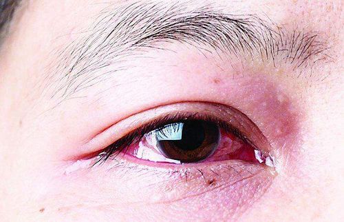 Mắt đỏ lại sau điều trị viêm màng bồ đào có sao không?
