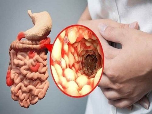 
Bệnh Crohn có các triệu chứng khác nhau tùy thuộc vào đường tiêu hóa mà bệnh ảnh hưởng
