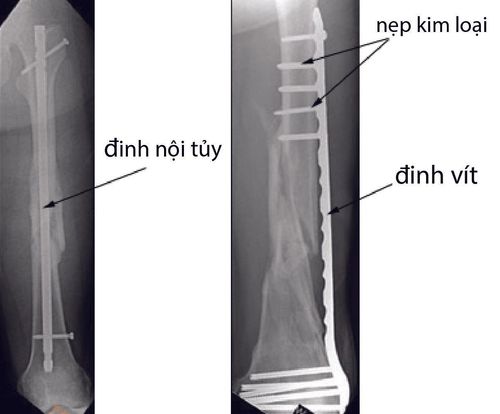 Đầu gối đau nhức sau mổ đóng đinh nội tủy gãy xương đùi hơn 1 tháng có sao không?