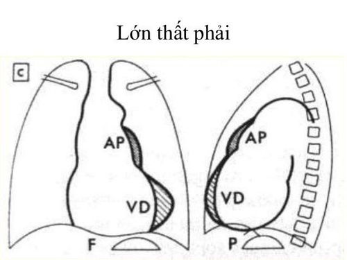 Tăng gánh thất trái phải điều trị thế nào?