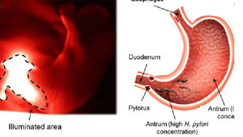 
Liệu pháp quang động học trong điều trị H.Pylori
