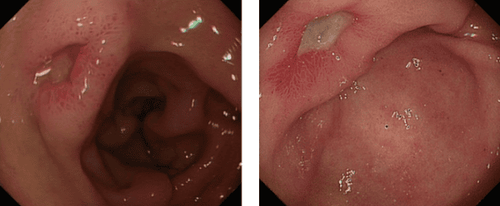 
H.Pylori được xác định là nguyên nhân chủ yếu gây loét dạ dày
